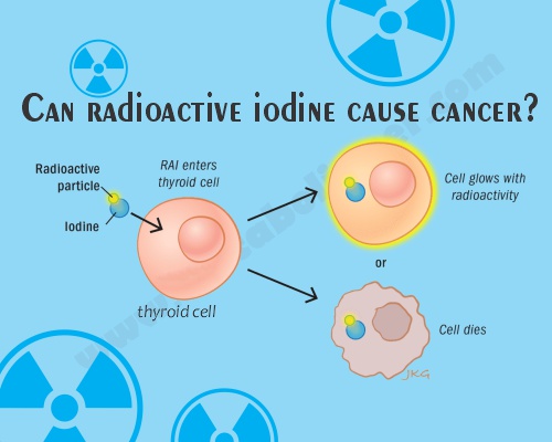 radioactive iodine